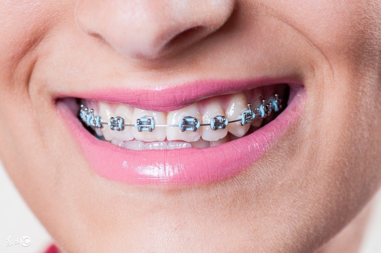 牙齿矫正中出现牙套脸该怎么办,牙齿矫正会出现牙套脸吗