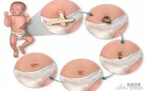 1-7天怎么护理新生儿脐带,新生儿宝妈催乳护理知识大全