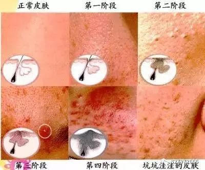 痘痘形成的内在原因和外在原因,痘痘形成的八大原因
