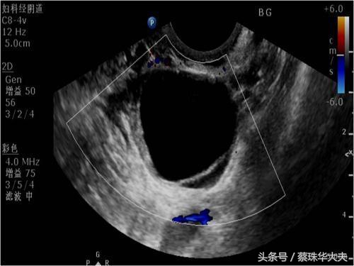 怀孕50天卵巢有20mm囊肿正常吗,怀孕50天发现有囊肿囊肿还不小