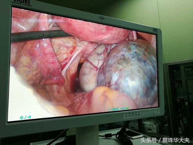 怀孕50天卵巢有20mm囊肿正常吗,怀孕50天发现有囊肿囊肿还不小