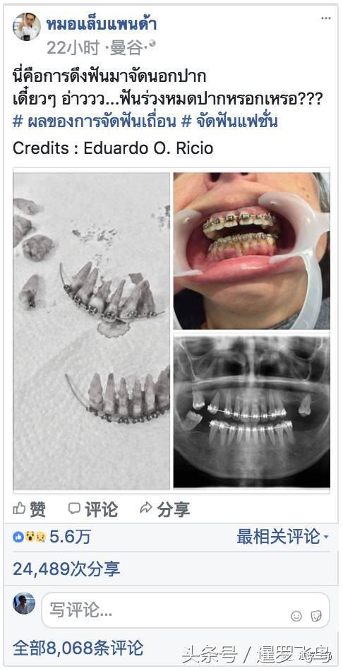爱美戴牙套导致整排牙齿脱落！看着都疼！泰国医生发文警示
