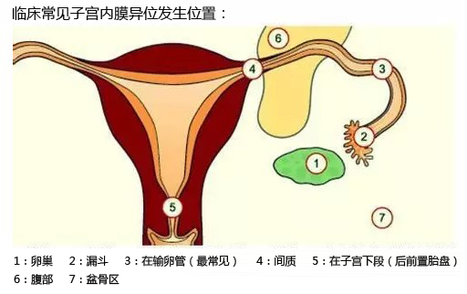 子宫腺肌症有什么治疗方法建议,子宫腺肌症最好治疗方法有哪些