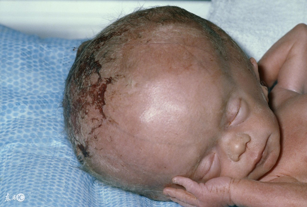 小儿脑积水的护理,小儿脑积水治疗最佳方法