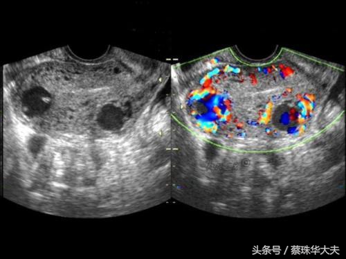 怀孕50天卵巢有20mm囊肿正常吗,怀孕50天发现有囊肿囊肿还不小