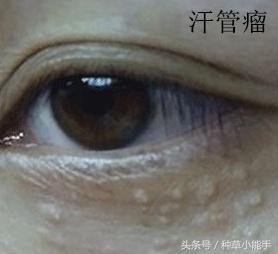 脂肪粒这件事｜眼霜表示：我不背锅啊！