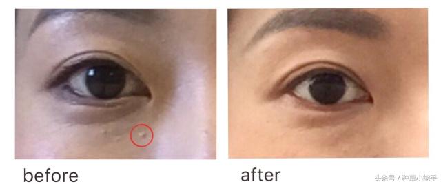 脂肪粒这件事｜眼霜表示：我不背锅啊！