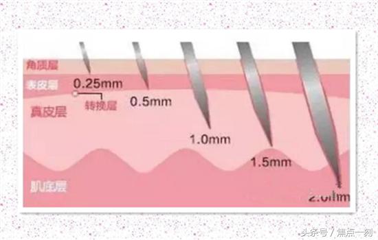 瘦脸针和玻尿酸的感受如何,瘦脸针和玻尿酸打哪个更持久