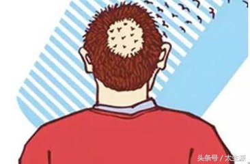 90后脱发大军,00后脱发快秃了