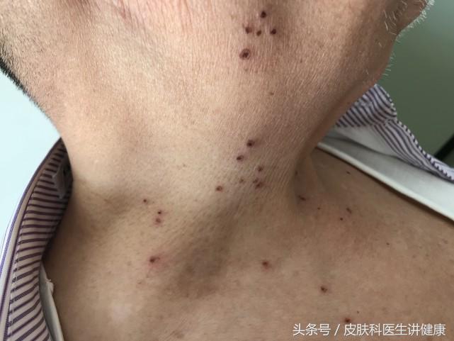 老年斑治疗骗局,养生堂治老人斑