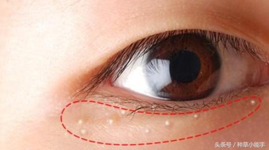 脂肪粒这件事｜眼霜表示：我不背锅啊！