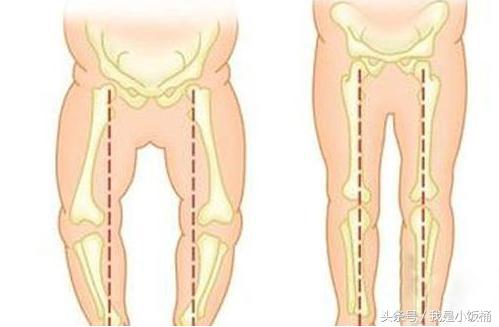不想宝宝变成八字脚o型脚就千万不要这样做