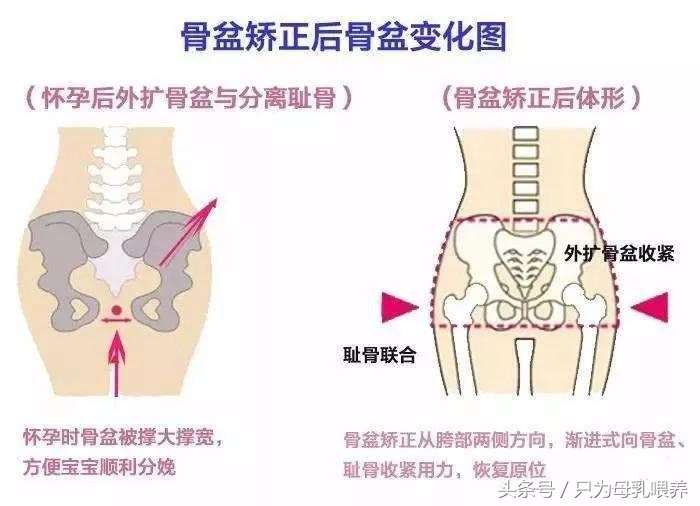 骨盆修复用什么方法做最好,顺产后修复骨盆最佳时机