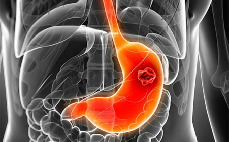 多学科会诊胃癌的介入治疗,多学科会诊是最佳的肿瘤诊治方式