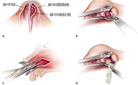 鼻出血鼻干燥,鼻出血与鼻炎有关吗