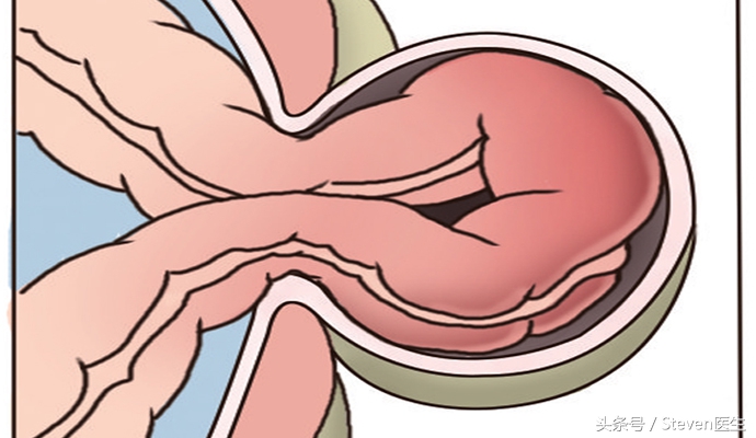 急性肠梗阻腹痛腹胀用什么药,急性肠梗阻引起的原因中医