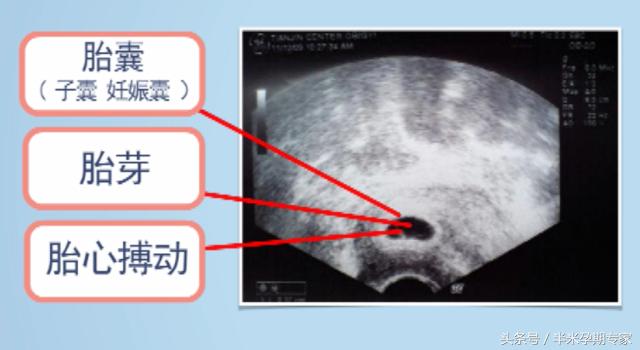 孕早期b超见胎心胎芽,孕早期如何从b超单上分辨婴儿