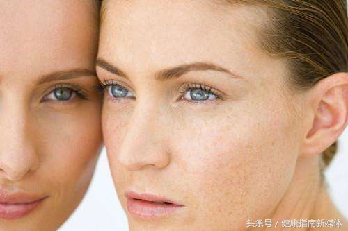 脸上的斑怎么才能去掉,脸上有片状斑怎么样才能去掉