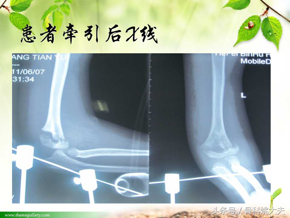 儿童肱骨干骨折处理方法,小孩胳膊肱骨骨折恢复最佳的方法