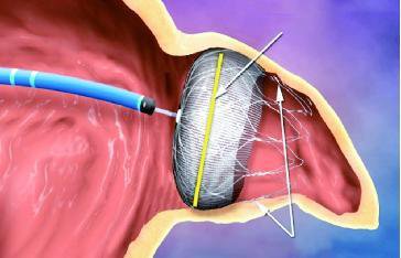 心脏房颤引起的脑梗该怎么治疗,医学教授讲治疗心脏房颤视频