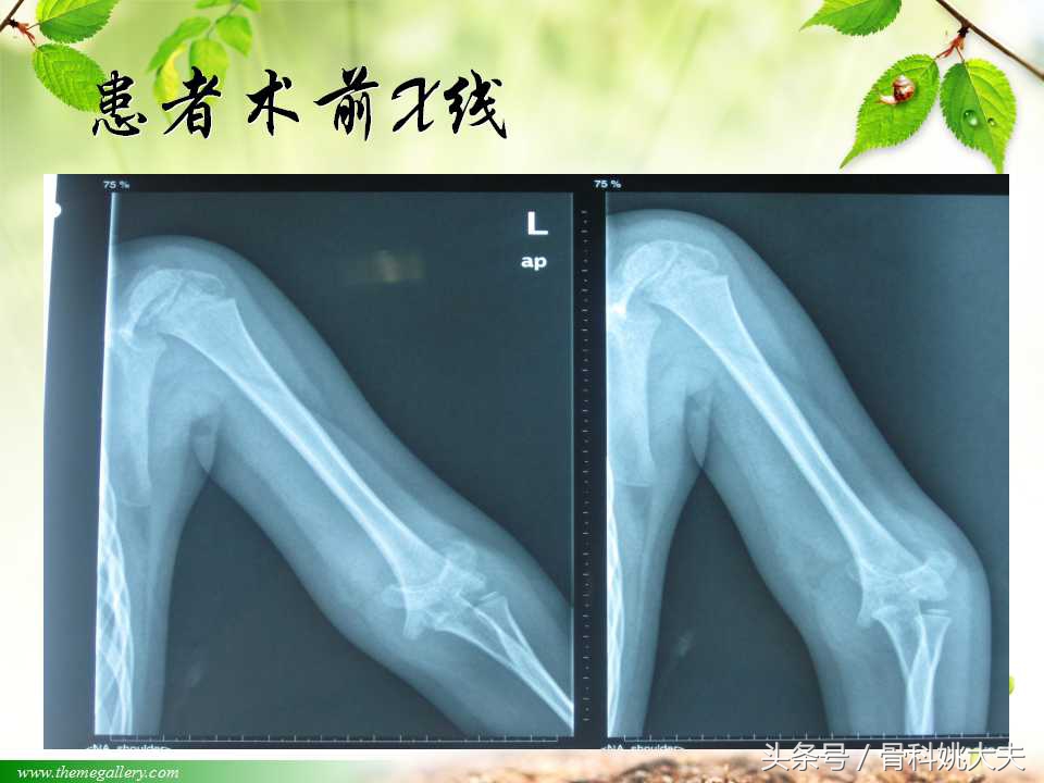 儿童肱骨干骨折处理方法,小孩胳膊肱骨骨折恢复最佳的方法