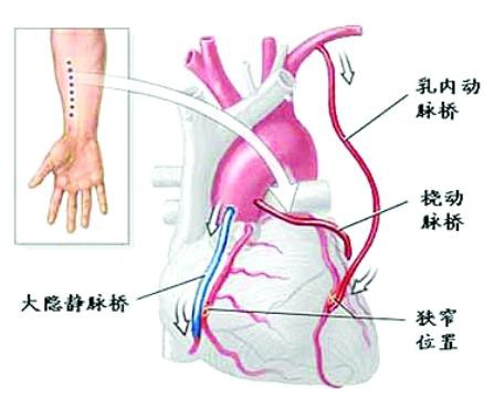 心脏搭桥后，“躺”得越久身体越差！医生都救不了你