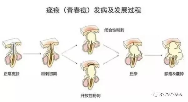 黑头痘痘粉刺去除过程护理,巨大粉刺型痘痘怎么治疗