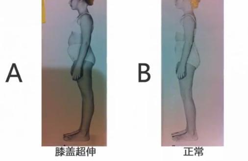 膝盖向里凹怎么矫正,影响身高的体态问题有哪些