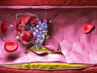 心脏房颤引起的脑梗该怎么治疗,医学教授讲治疗心脏房颤视频