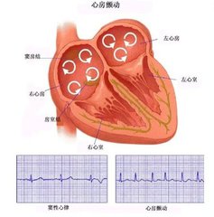 心脏房颤引起的脑梗该怎么治疗,医学教授讲治疗心脏房颤视频