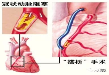 冠心病介入治疗是什么,安贞医院冠心病介入治疗新技术