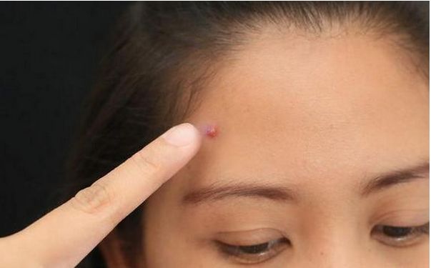 女性外面长了小痘,外面长什么痘里面就有什么病