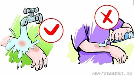 不小心烫伤了要涂什么药,不小心烫伤要怎么样才可以不烫