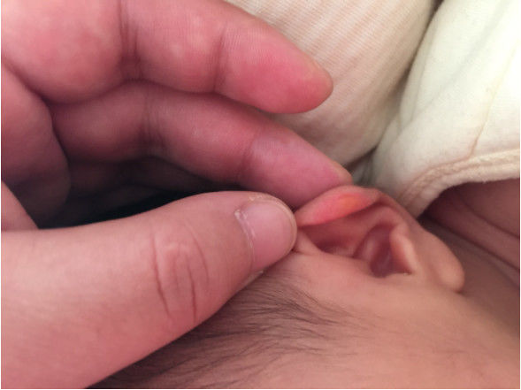 1月龄宝宝耳朵出血,宝宝耳朵出血痂几个月了还没好