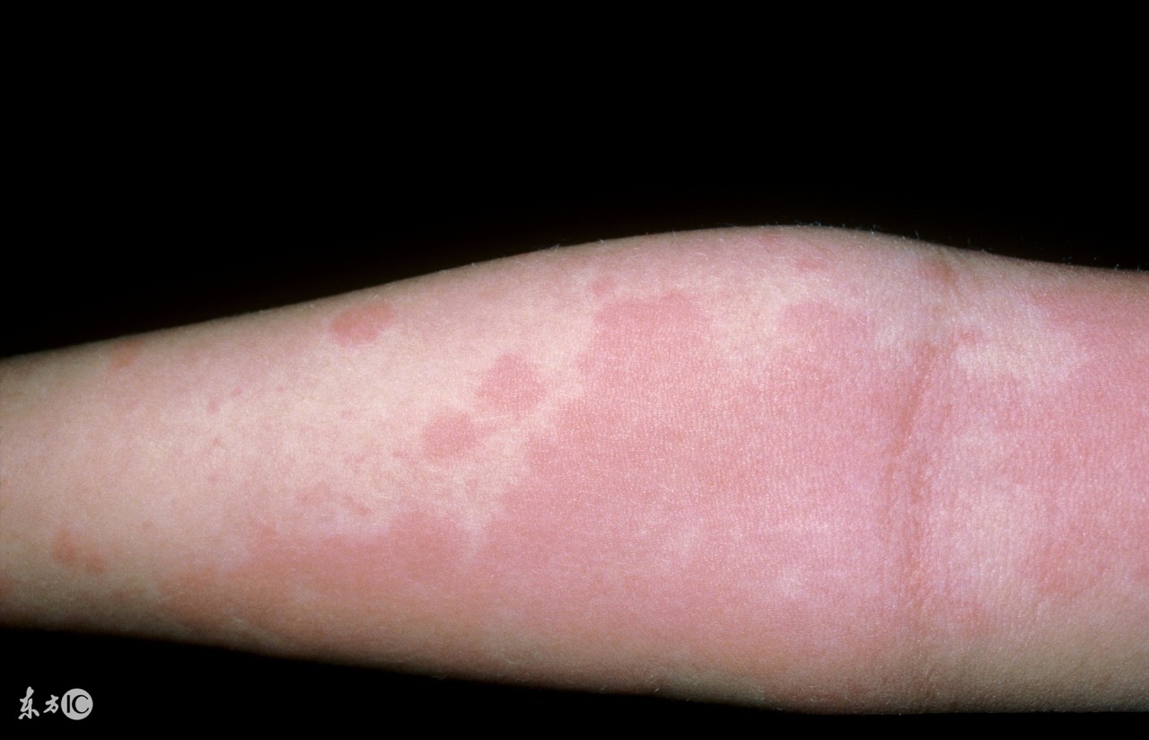 什么药治人工荨麻疹很有效,人工性荨麻疹吃什么药最有效