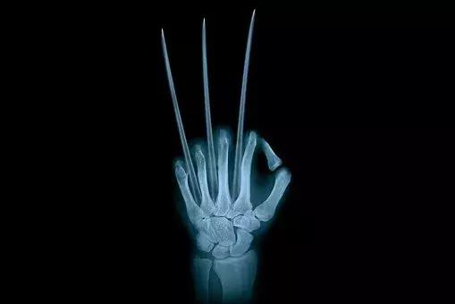 骨刺不治疗能不能自己好,年轻人骨刺怎么治才能彻底根除