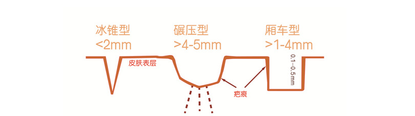 骞垮窞娣″寲鐥樺嵃鐥樺潙姣涘瓟绮楀ぇ,娣″寲鐥樺嵃鐥樺潙姣涘瓟绮楀ぇ鐢风敓