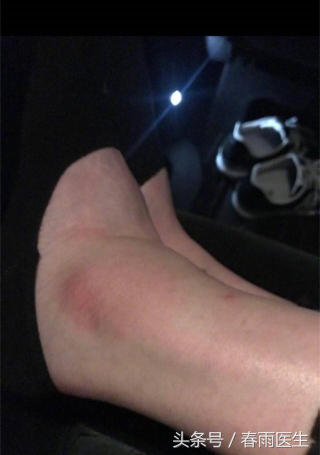 奚梦瑶维密大秀意外摔倒,奚梦瑶维密秀摔倒原因