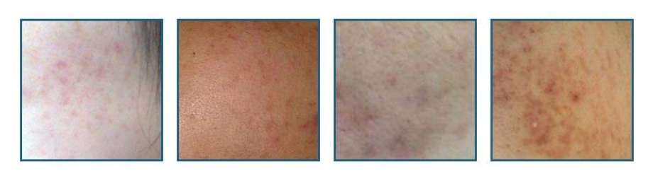 骞垮窞娣″寲鐥樺嵃鐥樺潙姣涘瓟绮楀ぇ,娣″寲鐥樺嵃鐥樺潙姣涘瓟绮楀ぇ鐢风敓