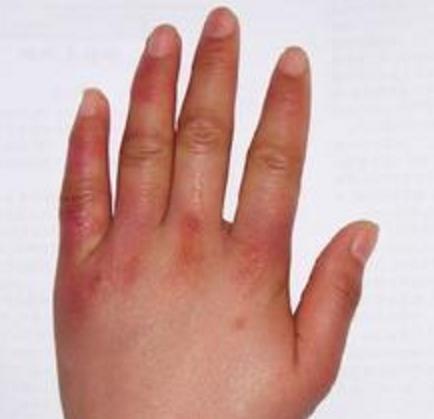 冻疮会一下子肿起来吗,冻疮会使手变粗