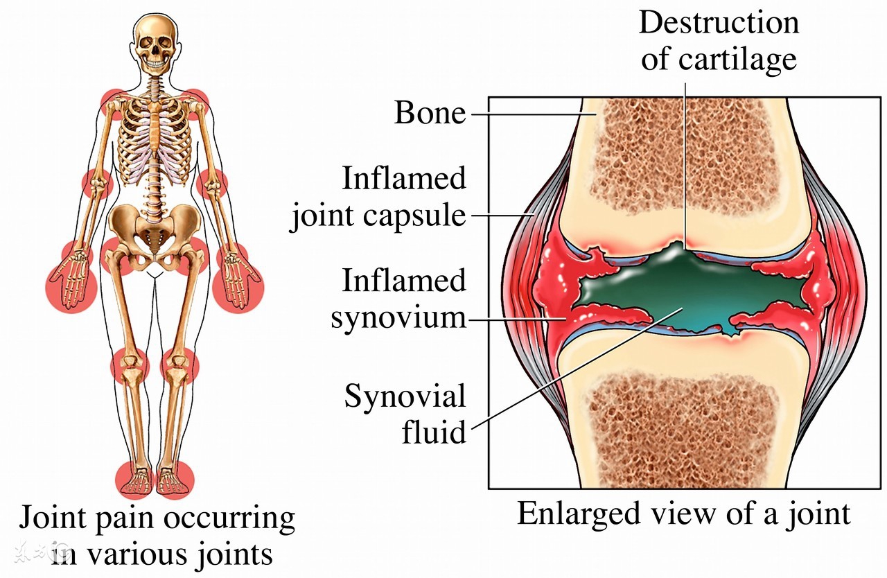 治疗类风湿性关节炎的药物有哪些,治疗类风湿性关节炎的最好的医院