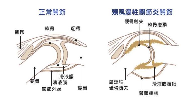 治疗类风湿性关节炎的药物有哪些,治疗类风湿性关节炎的最好的医院