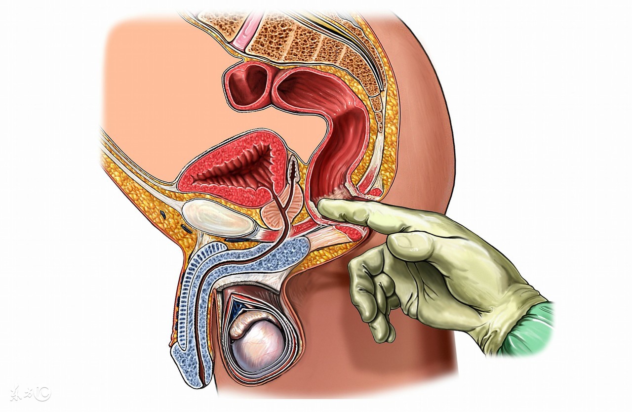直肠癌的早期症状和痔疮的区别,不是直肠癌容易被误诊为直肠癌吗
