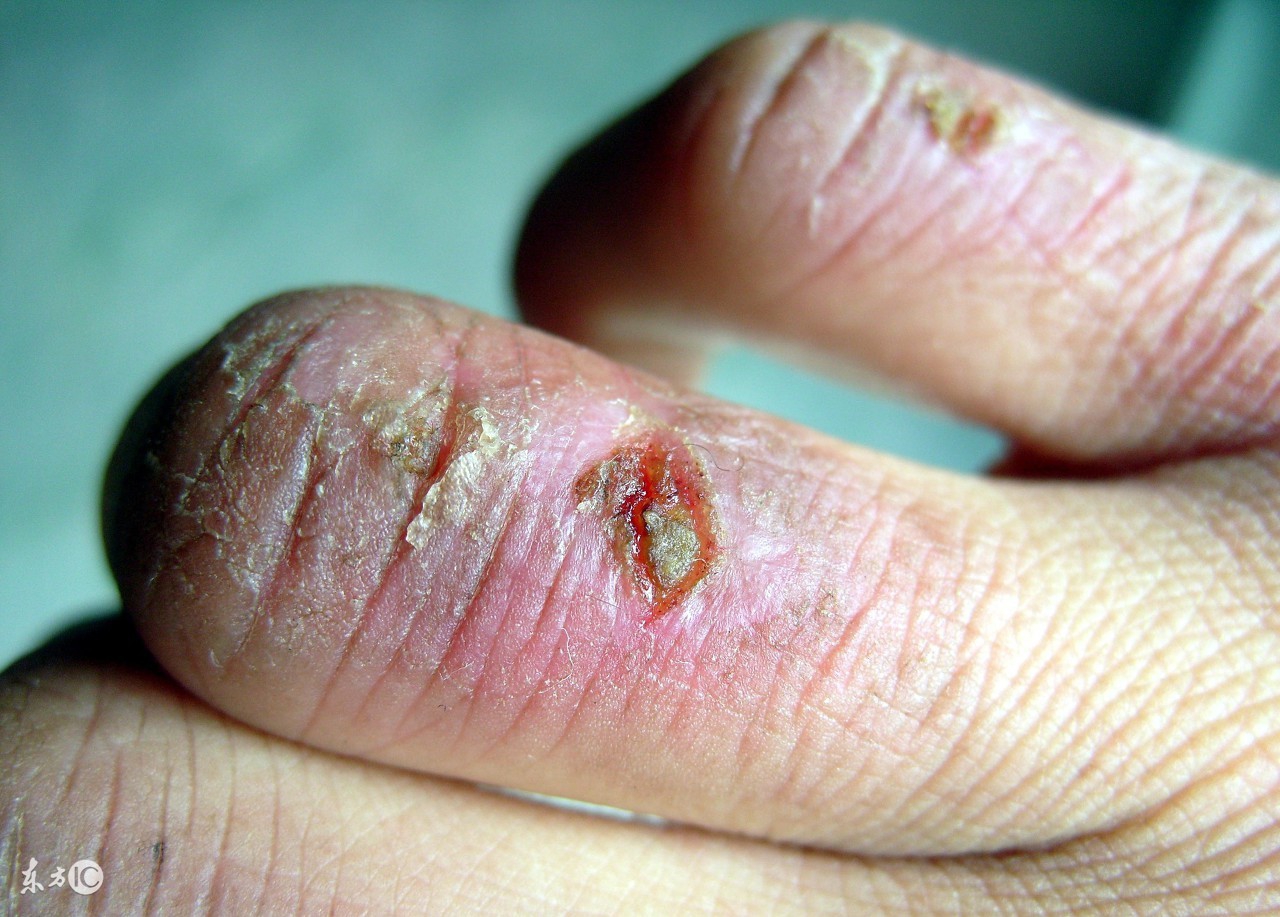 防止冻疮的五种小方法,冻疮的克星有哪些