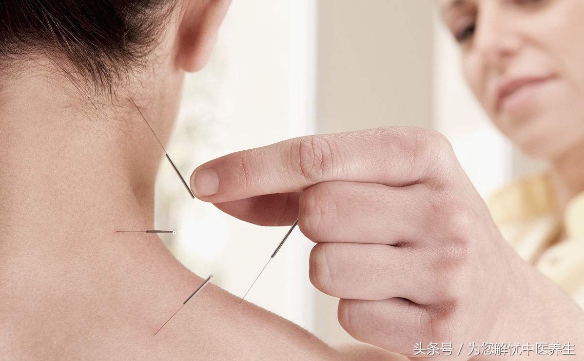 针刺治面瘫的原理,针刺放血治疗面瘫见效快