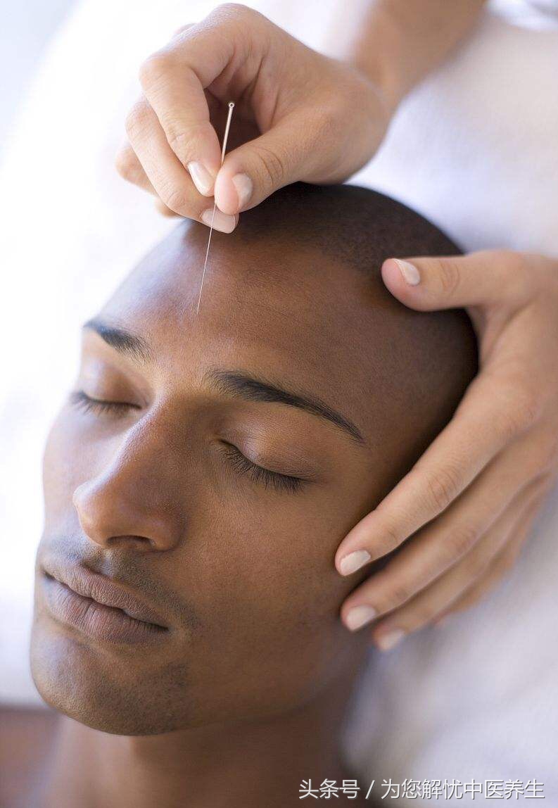 针刺治面瘫的原理,针刺放血治疗面瘫见效快