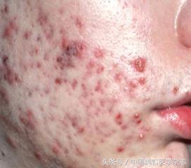 脉冲染料激光和强脉冲光,光电治疗痤疮多少钱