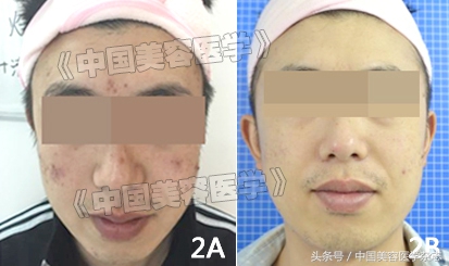 脉冲染料激光和强脉冲光,光电治疗痤疮多少钱