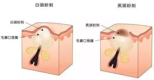 治疗闭口粉刺的中药,治疗闭口粉刺最有效的方法