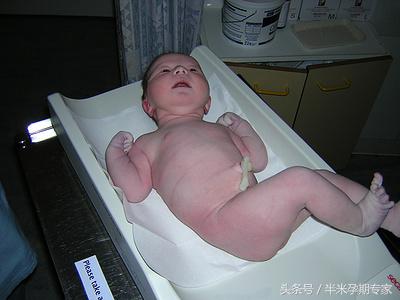 u型脐带压迹应关注啥,脐带边缘性附着需要关注什么